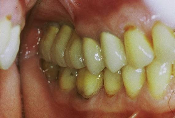 השתלות שיניים-אחרי השתלה