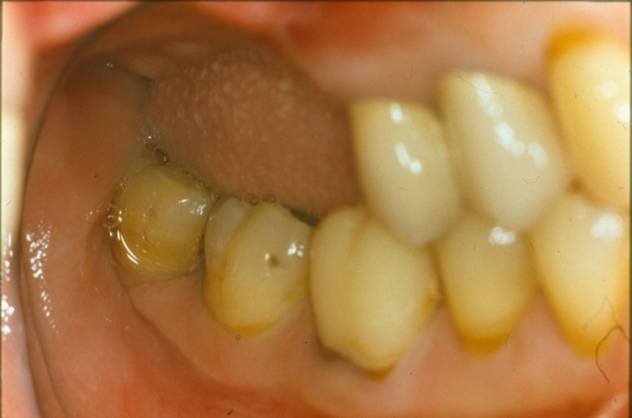 השתלות שיניים- לפני השתלה