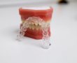 יישור שיניים ללא גשר