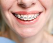 יישור שיניים למבוגרים – למה חשוב להשקיע ביישור שיניים גם בגיל מבוגר?